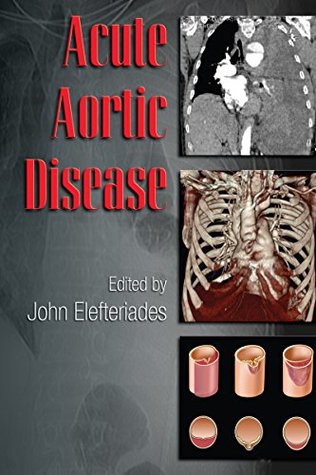 Download Acute Aortic Disease (Fundamental and Clinical Cardiology) - John A. Elefteriades | PDF